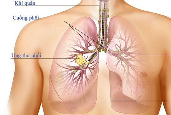 Ung thư phổi thường bộc lộ triệu chứng khi đã di căn xa