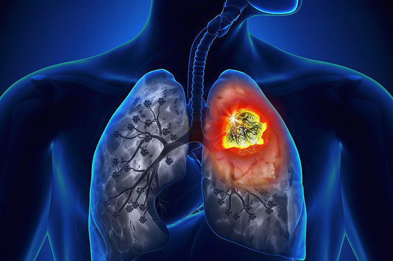 U phổi lành tính có di căn không?