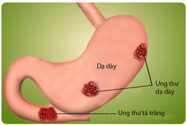 4 dạng bệnh dạ dày dễ phát triển thành ung thư
