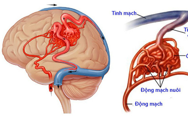 Đột quỵ não không chừa 1 ai...