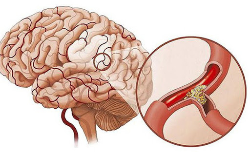 Nguyên nhân gây thiếu máu não