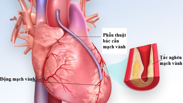 Bí quyết “chung sống hòa bình” với bệnh động mạch vành