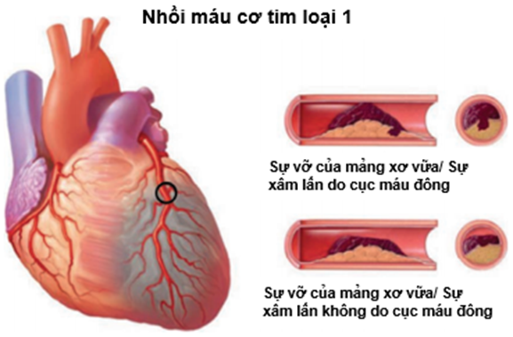 VIDEO - NHỒI MÁU CƠ TIM LÀ GÌ, ĐIỀU TRỊ NHỒI MÁU CƠ TIM NHƯ THẾ NÀO?