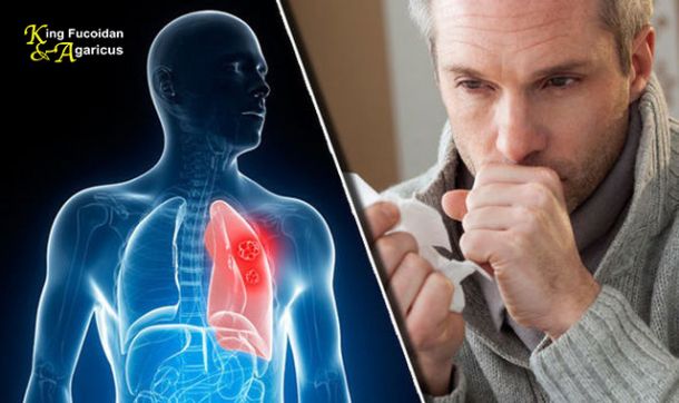 5 dấu hiệu sớm của ung thư phổi bạn cần biết