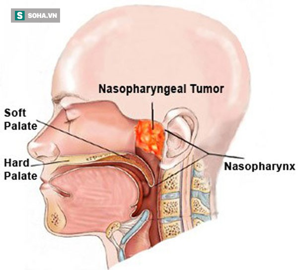 Nhớ các dấu hiệu ung thư vòm họng giai đoạn đầu