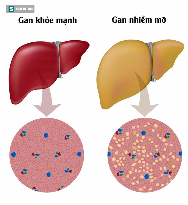 Nguyên nhân gây ra gan nhiễm mỡ và cách khắc phục