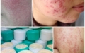 Biến chứng nặng nề do kem “làm trắng da”