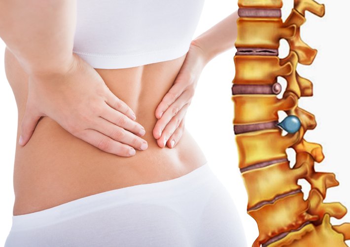 Thoát vị đĩa đệm: Thận trọng khi sử dụng thuốc chống viêm